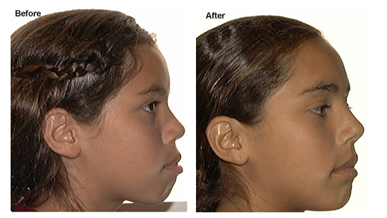 Protruding Lips Before And After Braces - Infoupdate.org