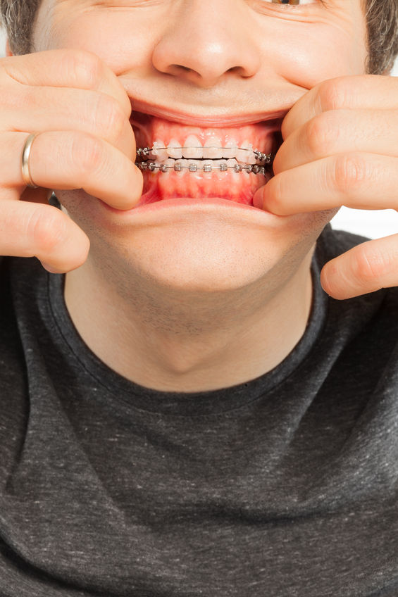 How To Stop Braces Pain Immediately Tips for Curing