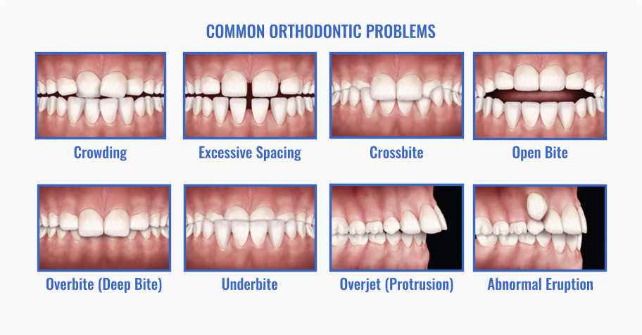 Dental Implants