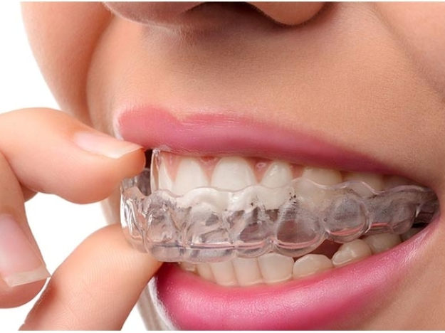 Invisalign Clear Aligner