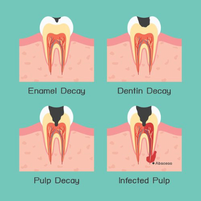 cavities in baby teeth