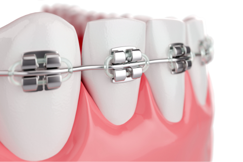 What are the Health Benefits of Braces?