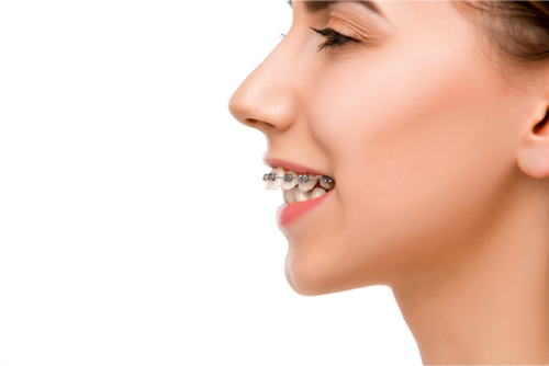 What are the Health Benefits of Braces?