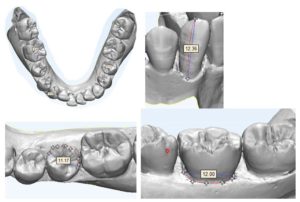 View of occlusal contacts in OrthoCAD® (Align Technology