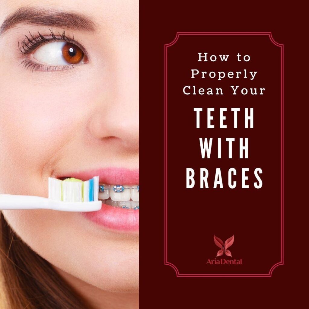 Cleaning Your Braces and Teeth Properly