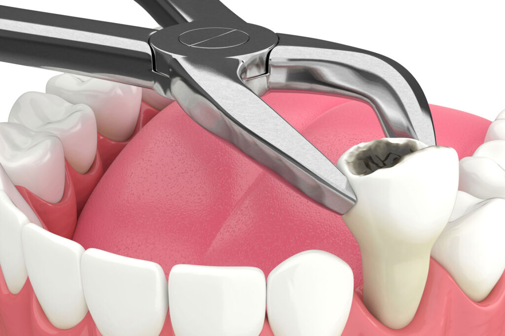 Teeth Extractions Will Leave No More Tooth Marks On Your American Heart In 2022