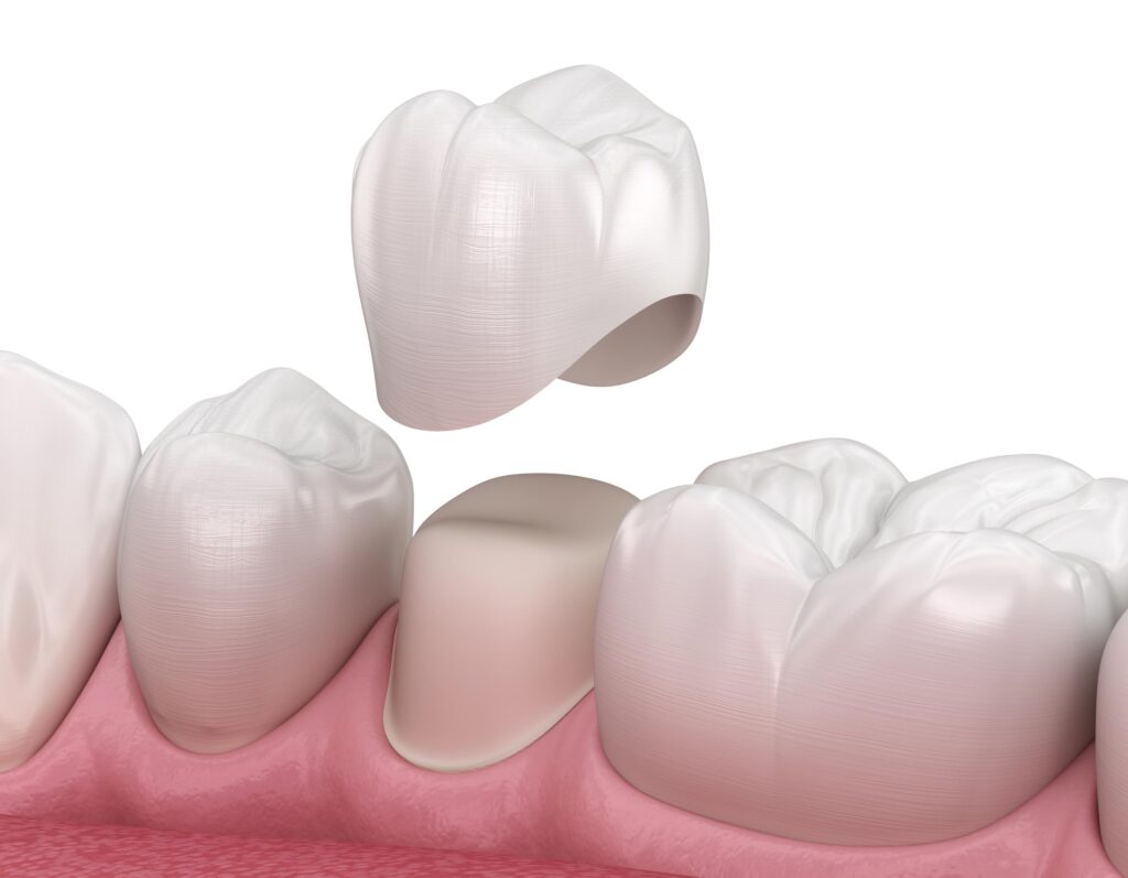 Porcelain Dental Crown