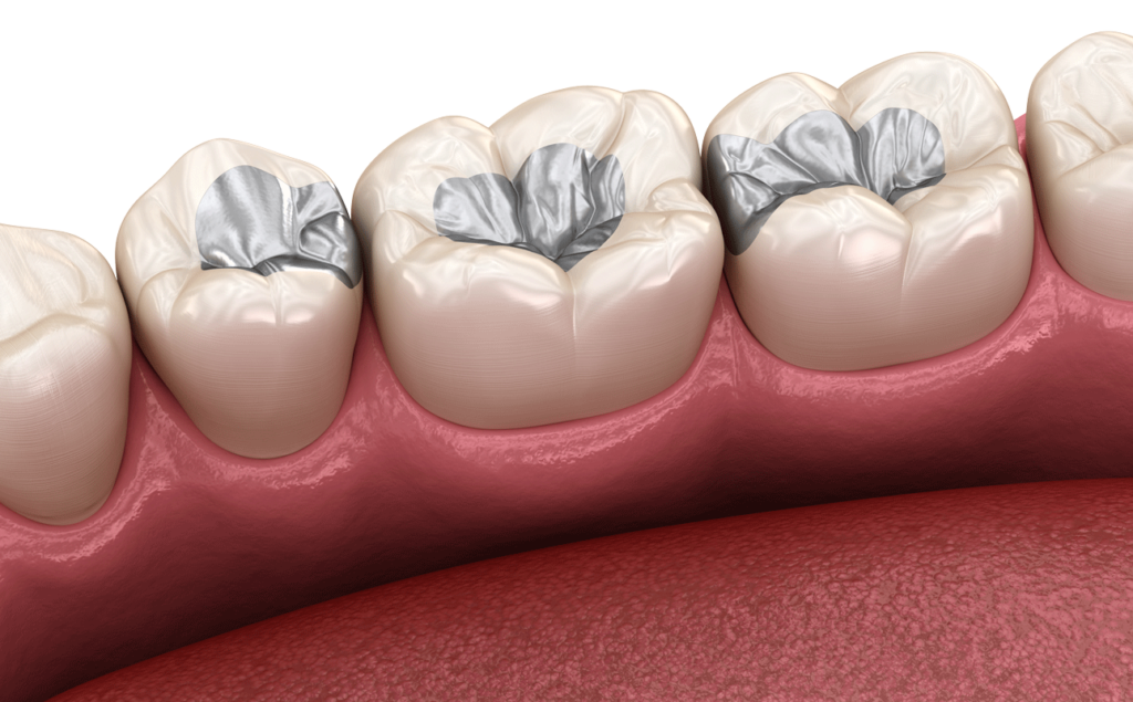 Amalgam Fillings