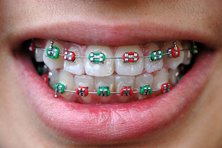 how to put rubber bands on braces