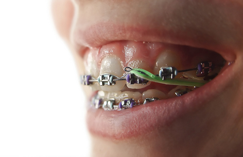 braces and rubber bands