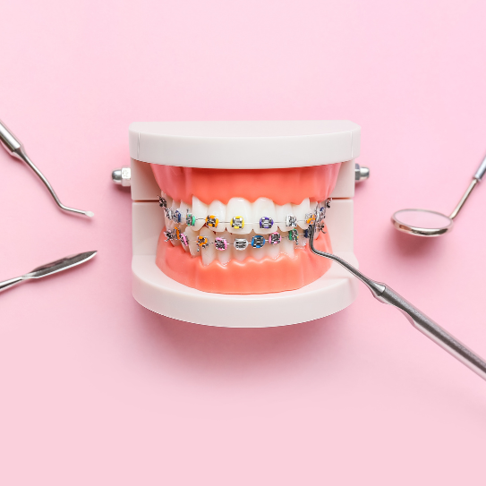 4 Tips to Keep Your Traditional Braces Clean