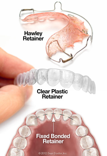 retainers braces wear always treatment removed need teeth types why orthodontic hold finished