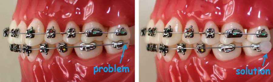 What can you do during an Orthodontic emergency?!