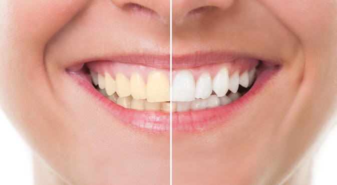 About The Charcoal Teeth Whitening Trend