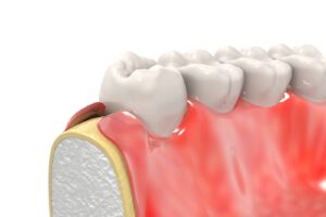 Model image of gum recession in a human jaw