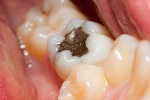 Mercury-Safe Dentistry in Worcester, MA