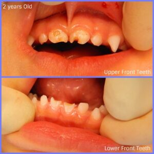 early cavities in baby teeth