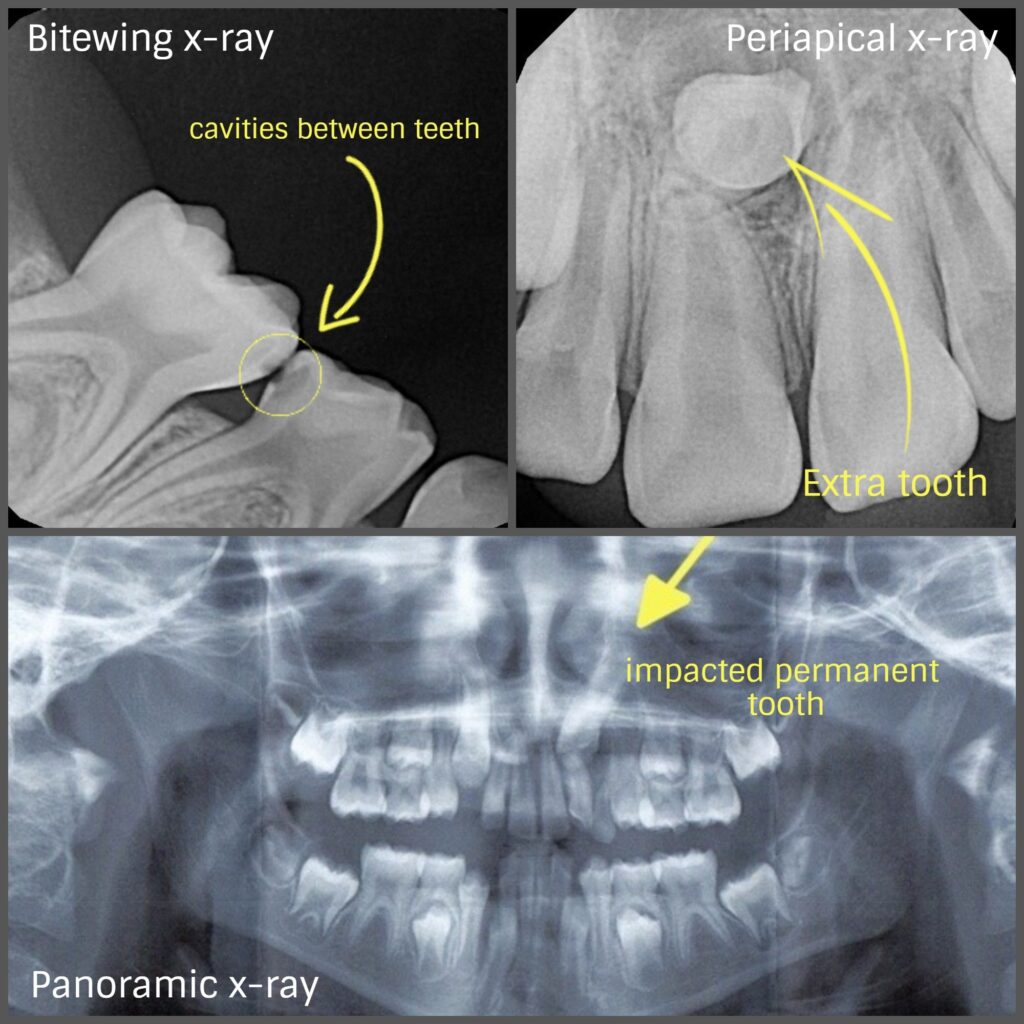 Faqs About Dental X Rays