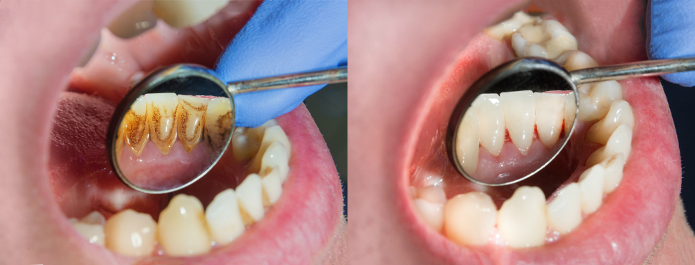 Tartar vs Plaque: What's the Difference? - Putney Dental Care