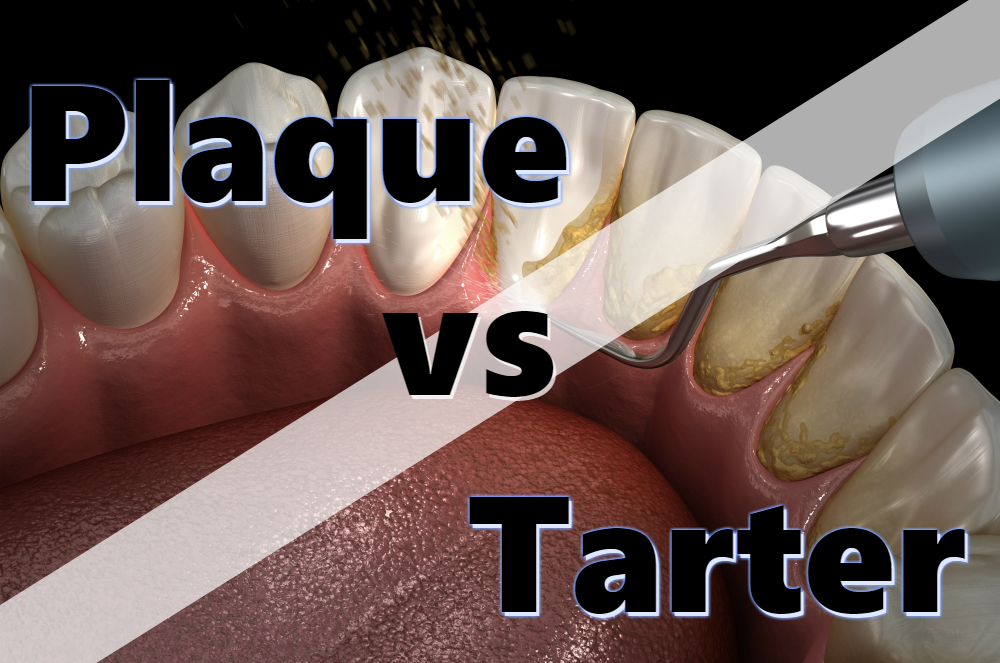 Plaque vs. Tartar