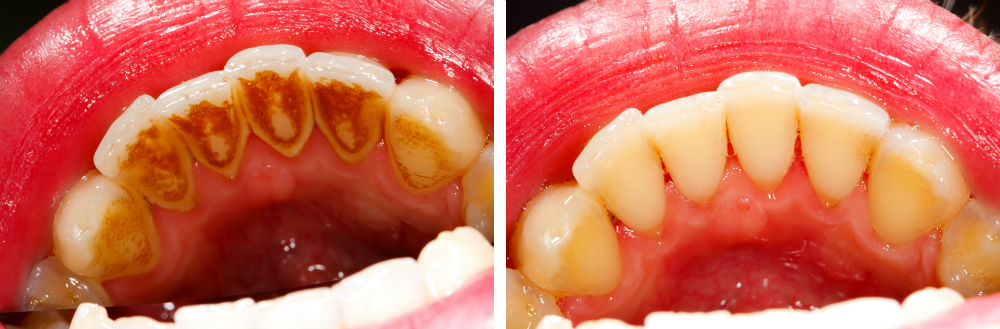 Differentiating Between Plaque and Tartar