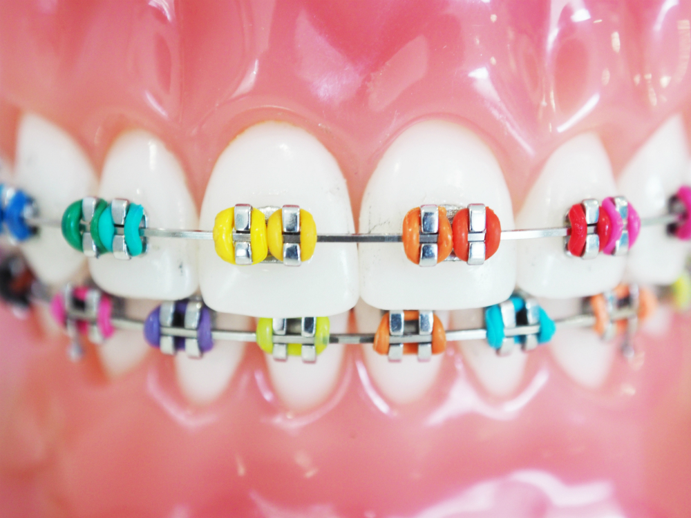 braces color wheel abq orthodontics