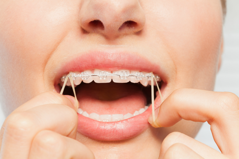 Importance of wearing your elastics - Belmar Orthodontics