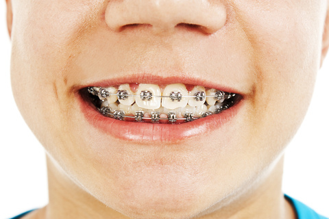 Invisalign® First Treatment - Embrace Orthodontics