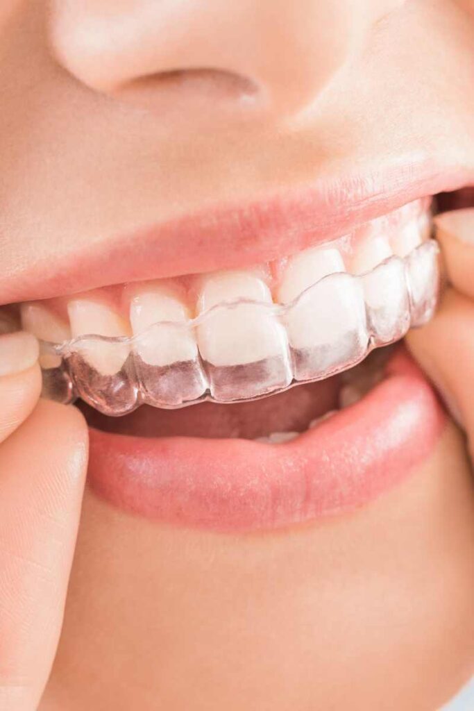 woman smiling with her invisalign aligners