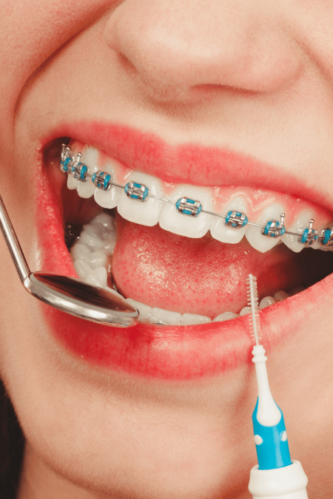 braces patient at a dental cleaning