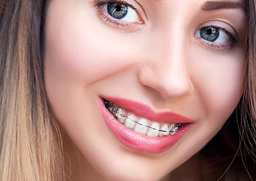 iDENTical Half Metal and Half Ceramic Brackets Orthodontics Model M3003X  Pink : : Health & Personal Care
