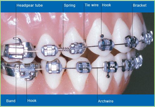 Types of Braces, Kashner Orthodontics