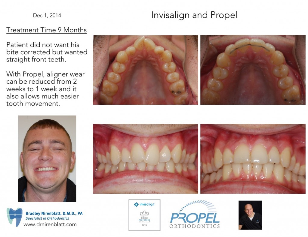 drnirenblatt propel invisalign