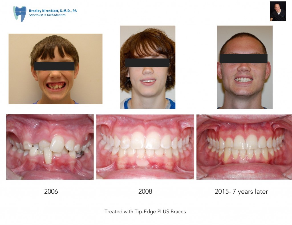 Nirenblatt Braces Crowded Teeth Orthodontist