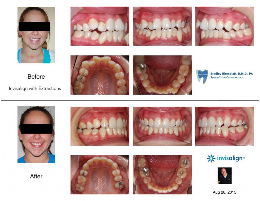 "Nirenblatt Invisalign Bicuspid Extractions"