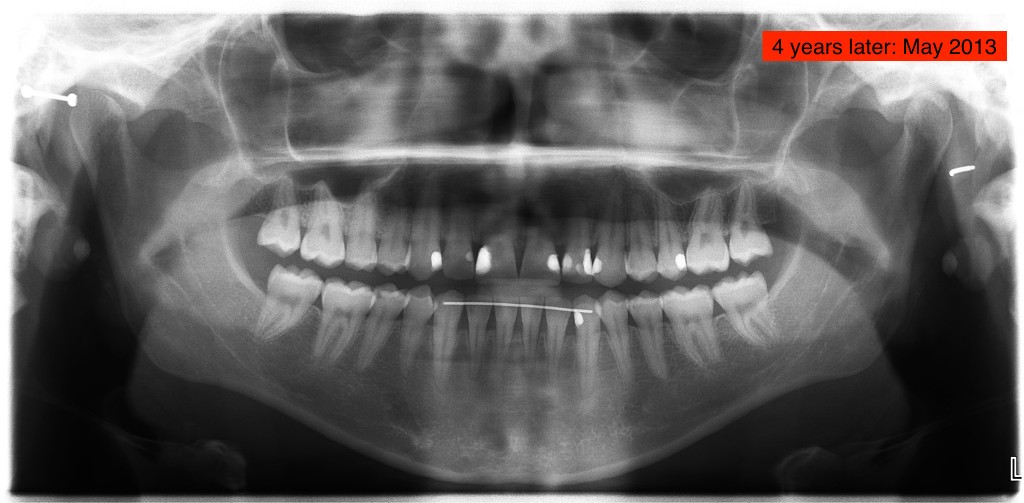 Nirenblatt Braces First Molar Extractions Pan