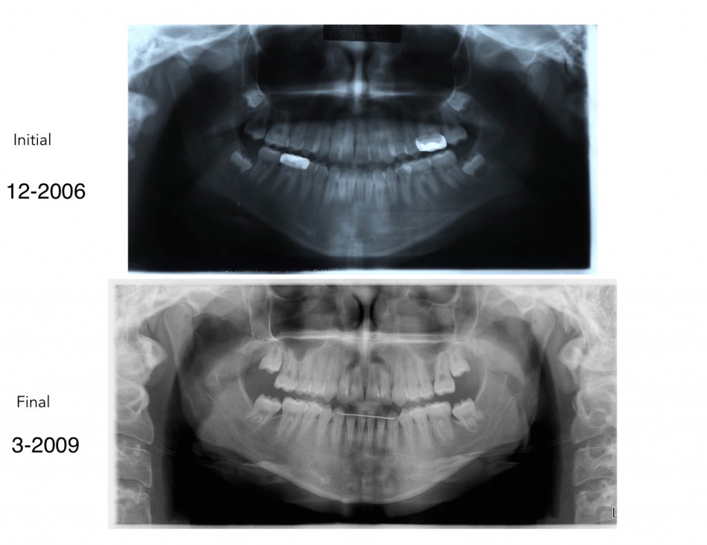 Nirenblatt Braces First_Molar Extractions Pan Tip-Edge