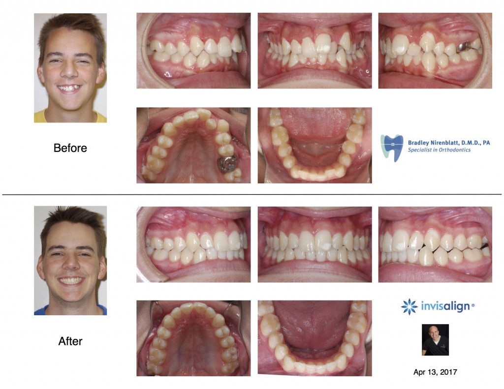 Invisalign Teen Extraction