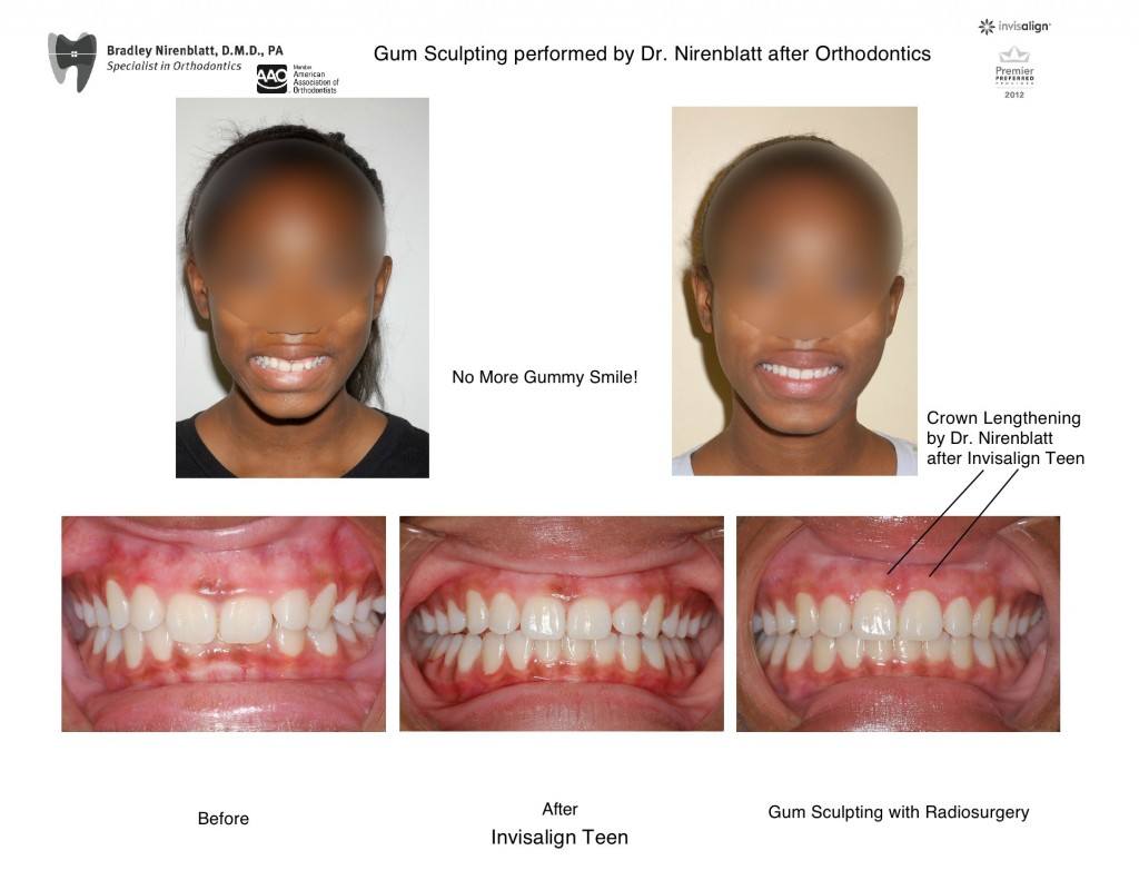 Invisalign Teen Gum Sculpting Radiosurgery