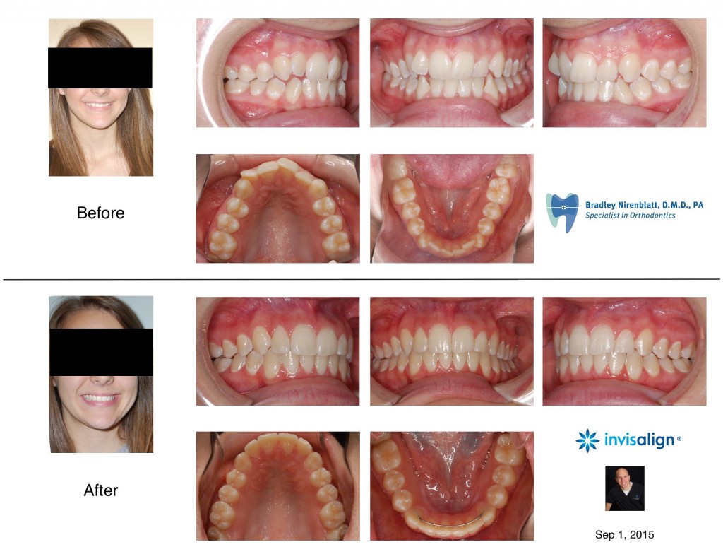 Nirenblatt Invisalign Openbite Crowding
