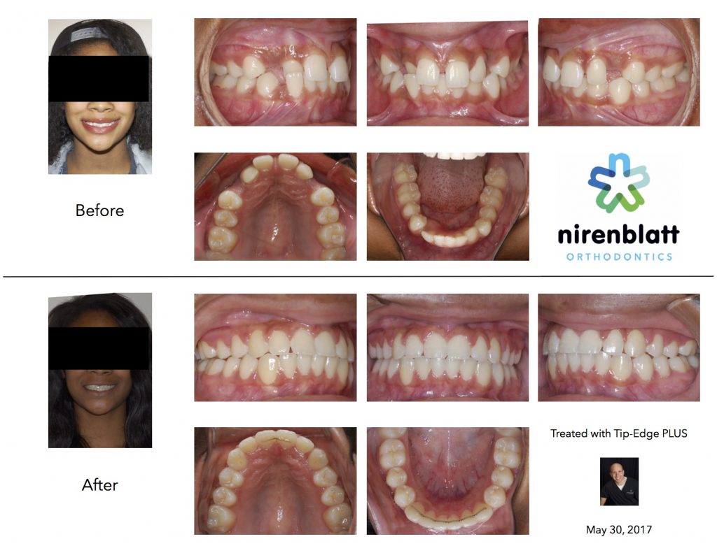 impacted canines nirenblatt