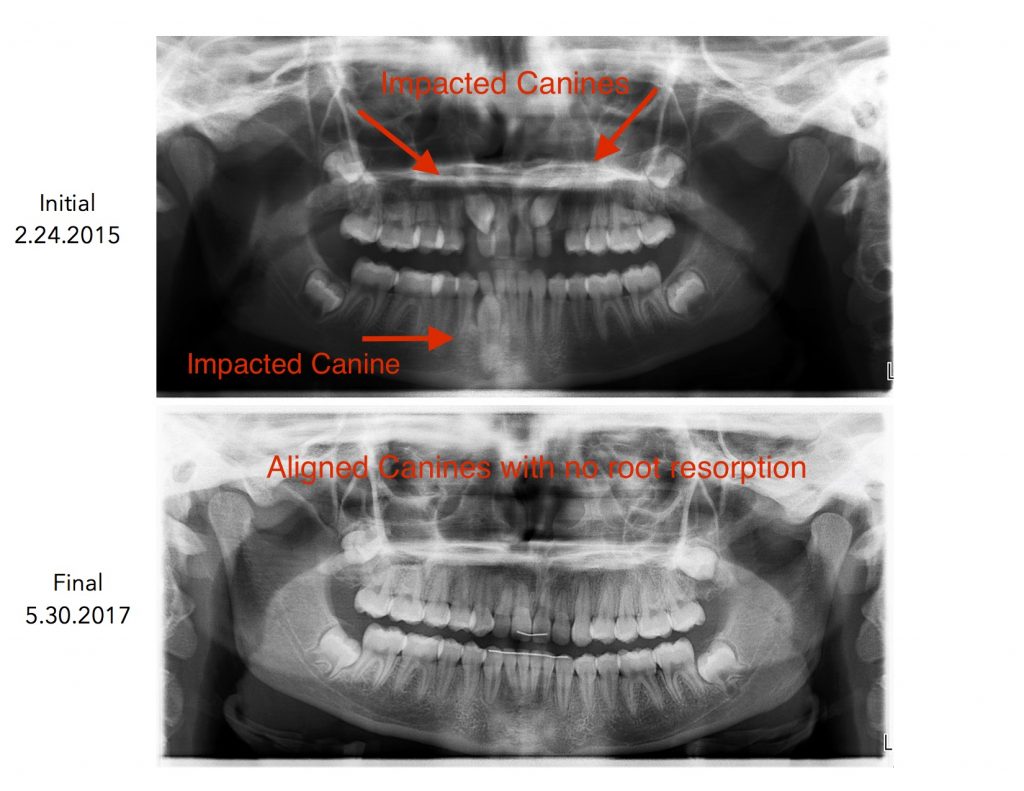 impacted canines nirenblatt
