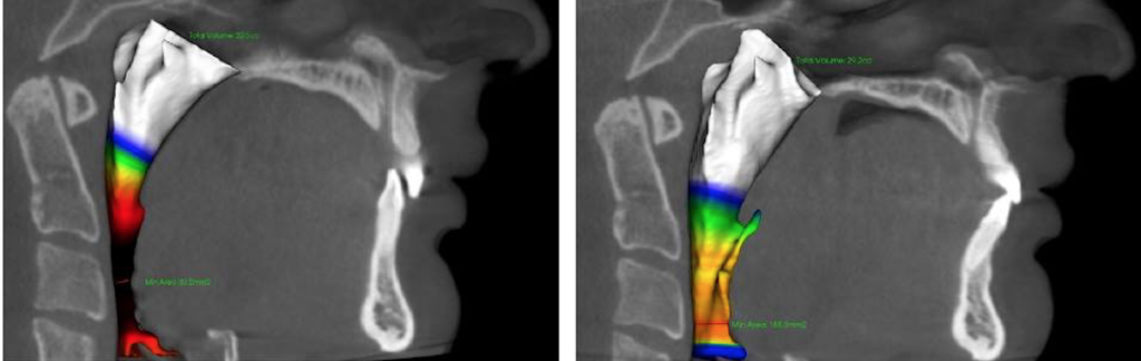 Airway before and after image by Marianna Evans et al.