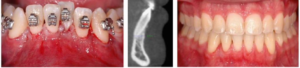 Immediately after procedure and final outcome.