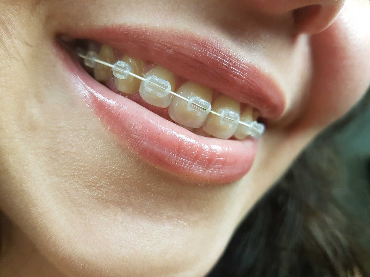 Adult Braces On The Rise