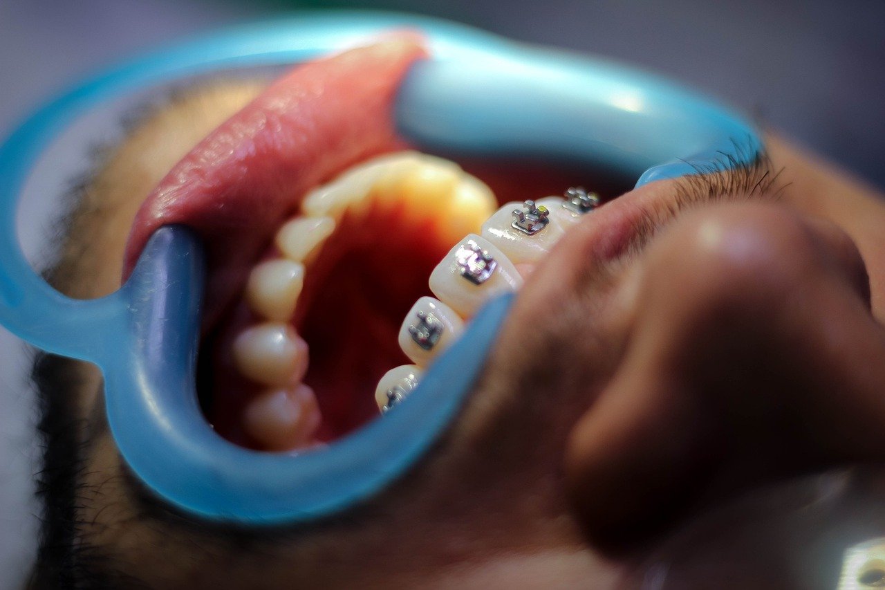 orthodontics celebrities braces