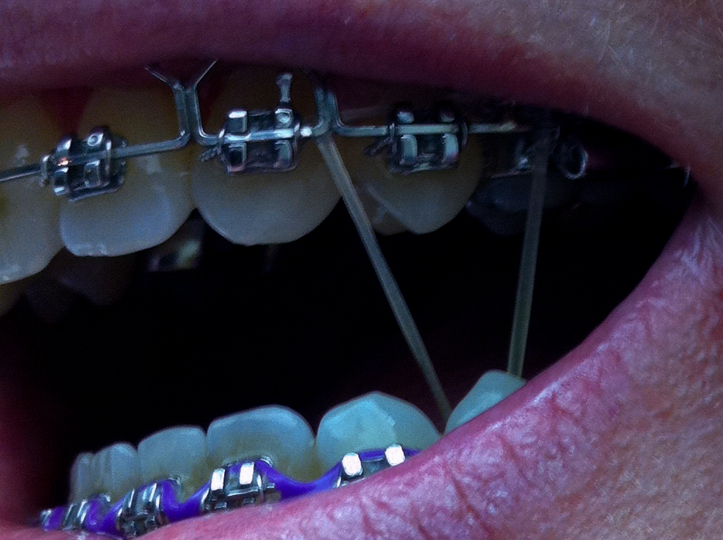 How Do Orthodontic Elastics Work?