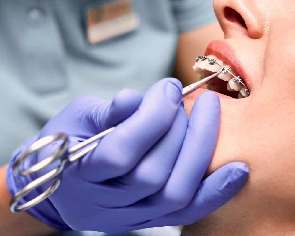 An orthodontist tightening someone’s braces