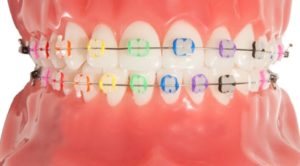 Rubber Band Tips For Orthodontic Patients - Orthodontist Dublin