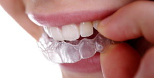 The Truth About DIY Clear Braces - McDonald Orthodontics